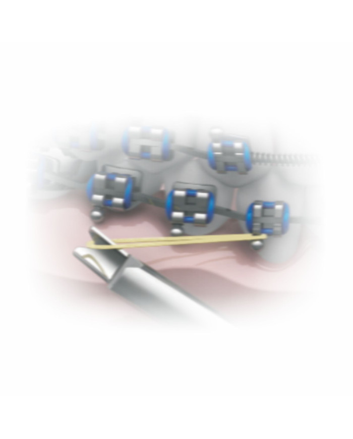 Tensiômetro Ortodôntico 100g-1600g