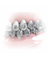 Elásticos Intra-oral Silicone