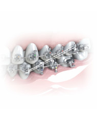 Elásticos Intra-oral Silicone