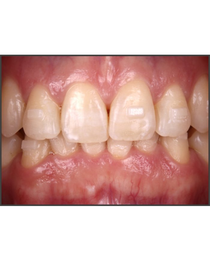 Composito Vittra APS Unique FLOW - seringa 2g