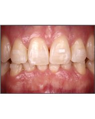 Composito Vittra APS Unique FLOW - seringa 2g