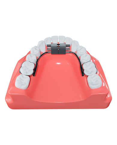 Mini Hyrax p/ disjunção Palatina 9mm - 1un