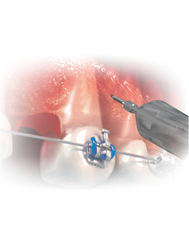 Kit Ferramentas p/Mini Implante Orto. c/Estojo - Rosa