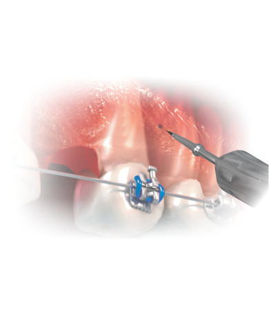 Kit Ferramentas p/Mini Implante c/Estojo - Azul