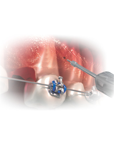 Kit Ferramentas p/Mini Implante c/Estojo - Azul