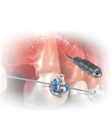 Kit Ferramentas p/Mini Implante c/Estojo - Azul