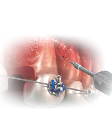 Kit Ferramentas p/Mini Implante Orto. c/Estojo